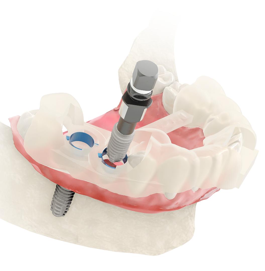 Bone Grafting for Dental Implants