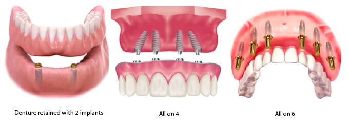 How many implants for full mouth rehabilitation - All-on-4 vs All-on-6