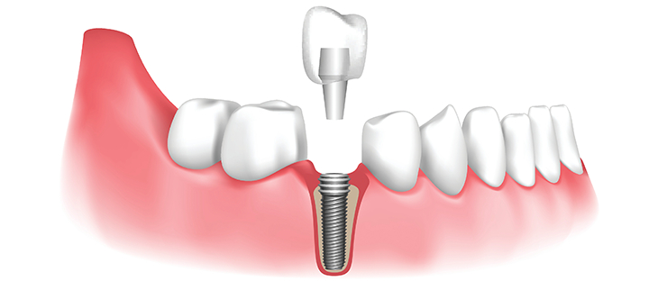 Questions to ask before dental implants in Pune